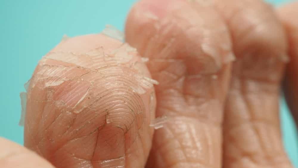 Что делать, если облазит кожа – лечение в Клинике Медитон