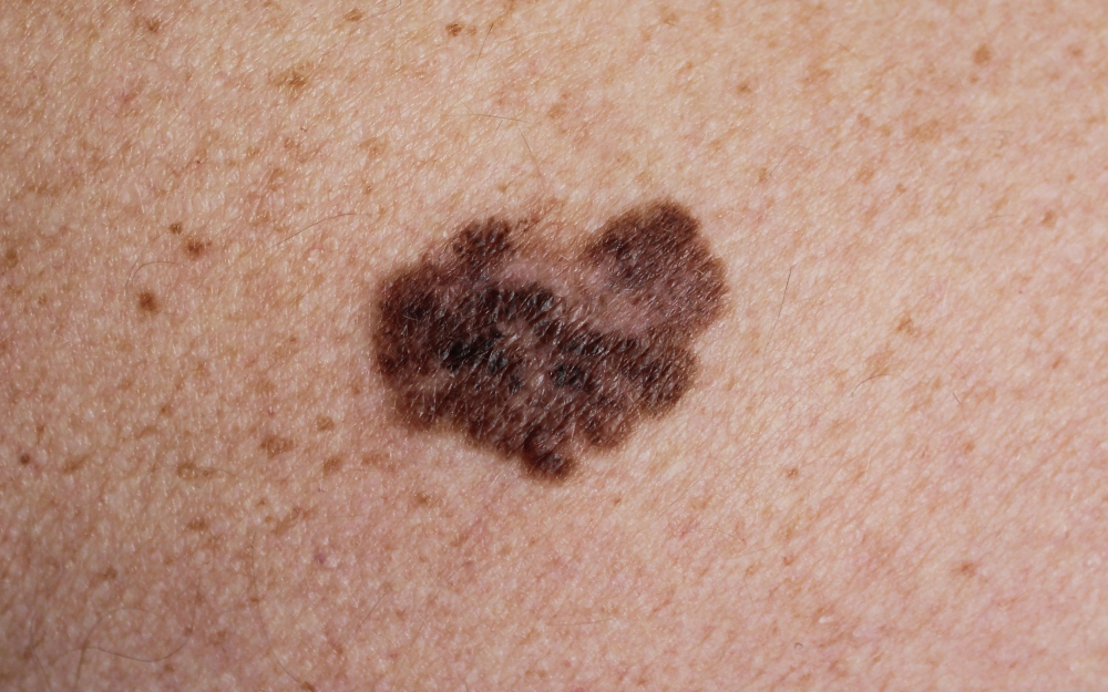 Лечение меланомы кожи: какие виды лекарственной терапии доступны? | Читать на gkhyarovoe.ru