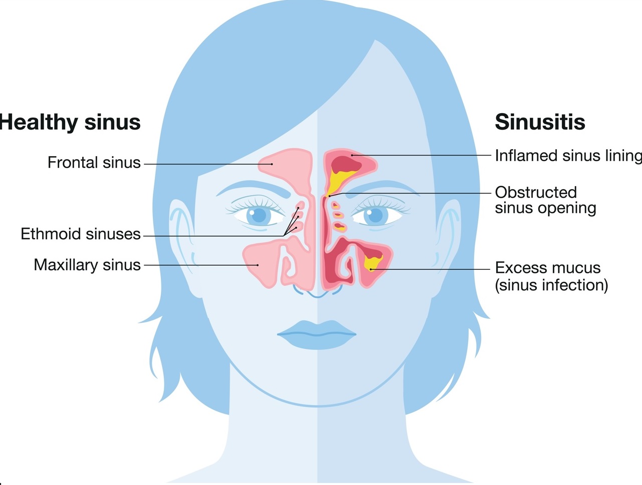 Masajes para la sinusitis