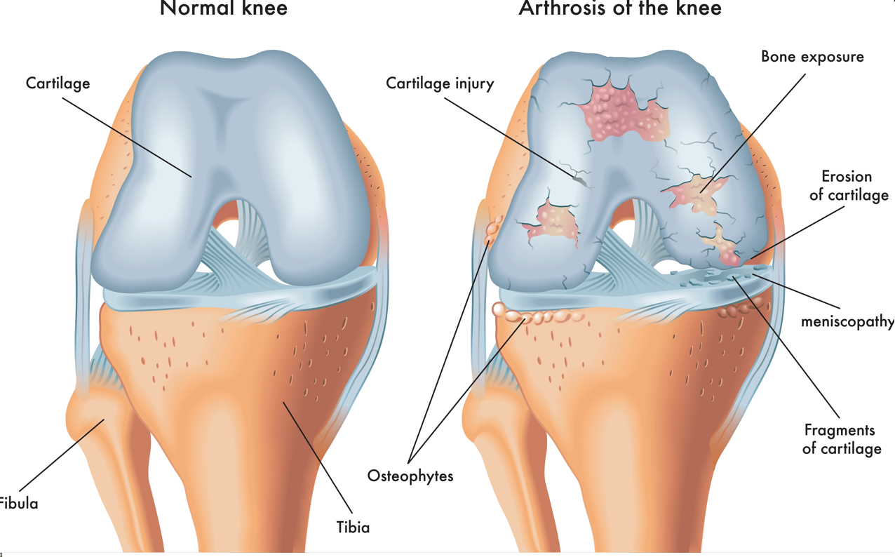 Артроз коленного сустава название. Повреждение хряща коленного сустава. Деформация остеоартроза коленного сустава. Суставные хрящи коленного сустава. Разрыв хряща коленного сустава.