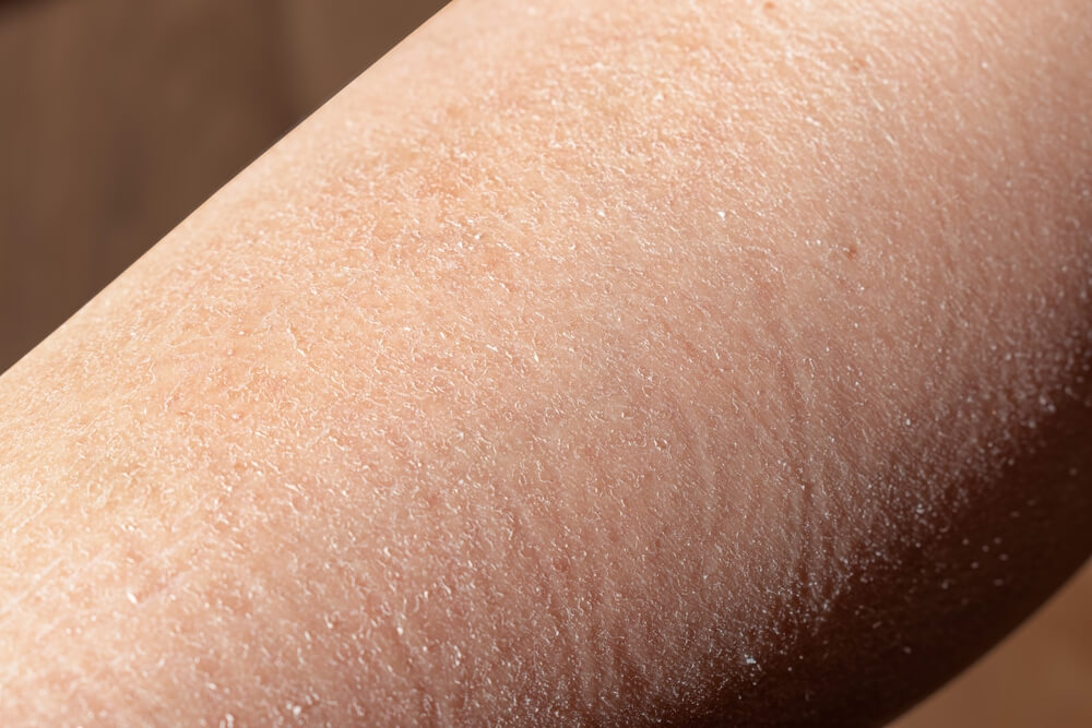Как ухаживать за сухой и обезвоженной кожей?