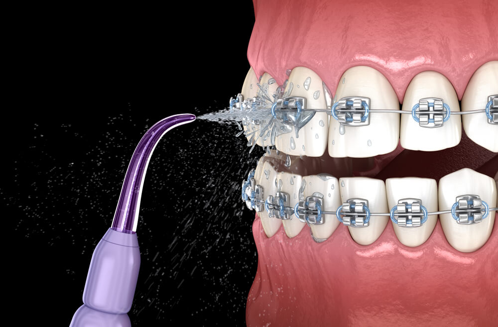 Как пользоваться ирригатором для полости рта и для чего он нужен?
