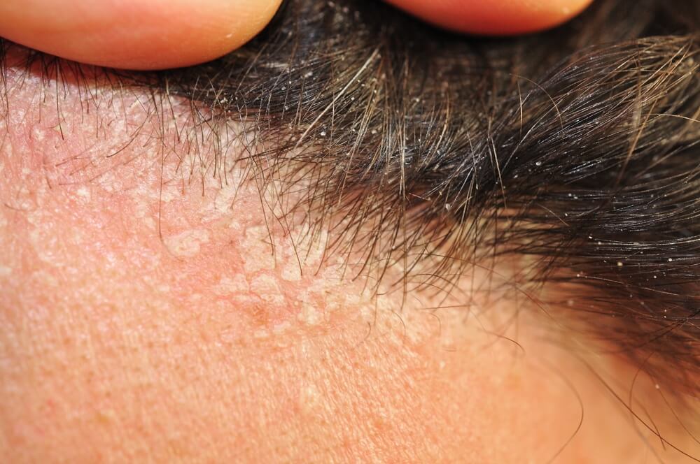 Заболевания кожи головы: причины, симптомы, лечение