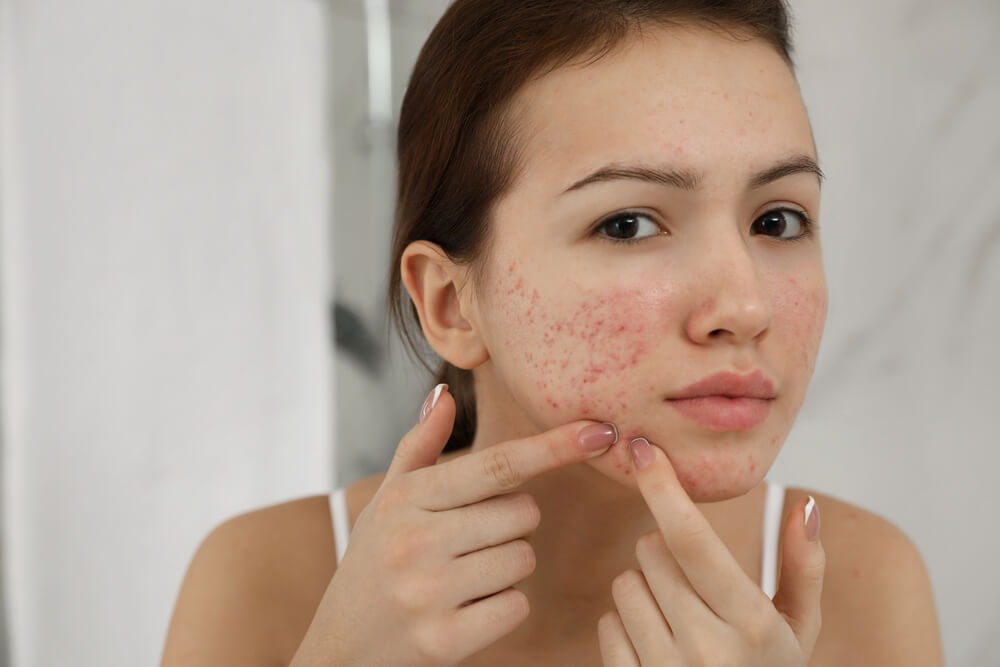 Угревая сыпь: как избавиться от прыщей и угрей на лице, причины и меры  профилактики