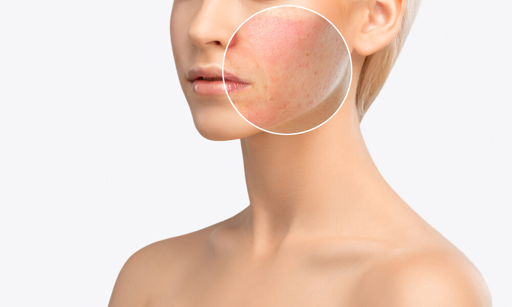 Уход за жирной кожей с акне: отзыв о лечении, косметические средства, советы дерматолога