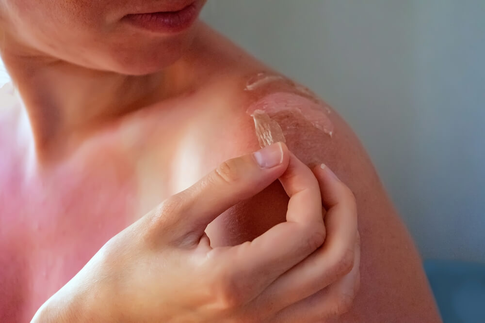 Устранить шелушение и сохранить загар: советы для тех, кто не применял солнцезащитные средства