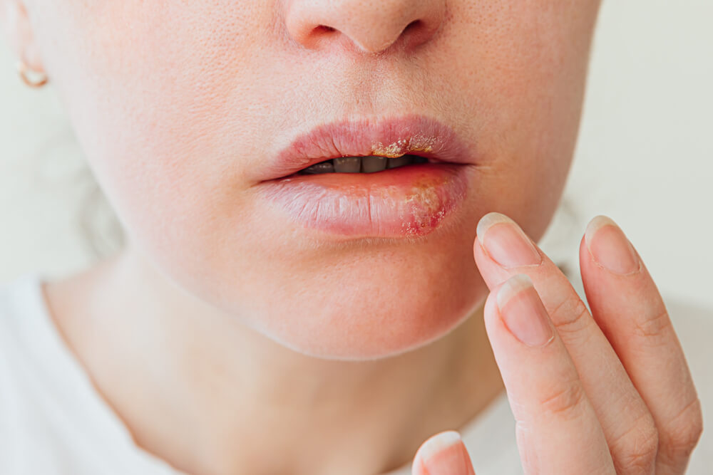 Герпес на губах: лечение народными средствами быстро