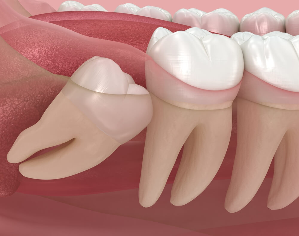 Лечение отека при удалении зуба