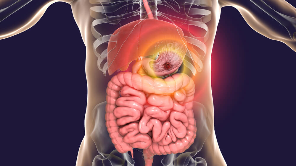 Язва желудка: признаки, симптомы, лечение - МедКом