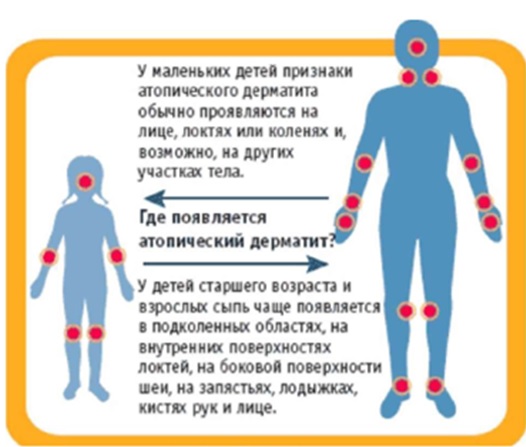 атопический дерматит