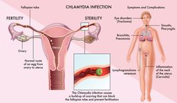 Хламидиоз: причины, симптомы, лечение
