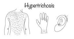 Гипертрихоз: симптомы и лечение