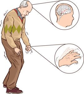 Тремор рук: почему трясутся руки, симптомы и лечения - FitoBlog