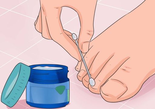 Лечение грибка ногтей Неумывакин: методика, рецепты, отзывы