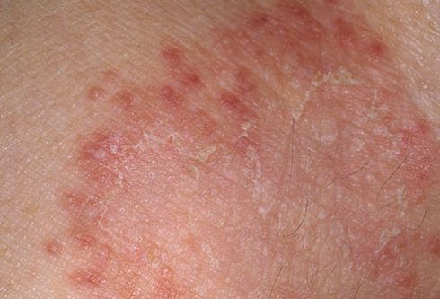 Кандидоз кожи — симптомы, диагностика и методы лечения | Альтермед
