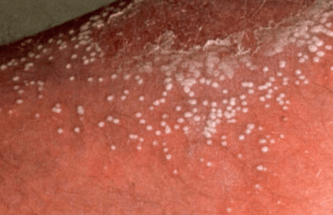 Грибковые заболевания кожи: симптомы и лечение, как избавиться от патологии навсегда