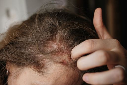 Зуд кожи головы: почему возникает и как его лечить?