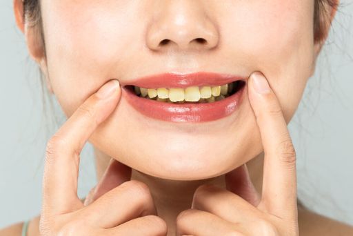Желтые зубы: причины и лечение