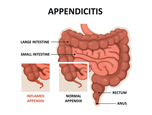 Аппендицит: симптомы, причины и лечение