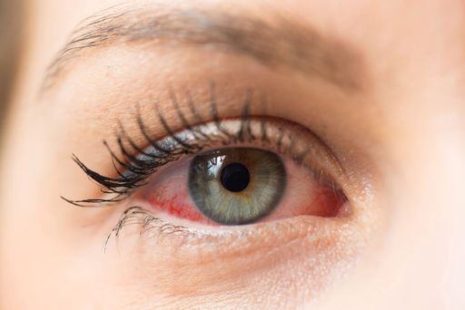 Cиндром сухого глаза: симптомы, причины и лечение