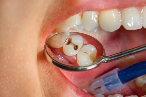 Кариес зубов: симптомы, причины возникновения и способы лечения