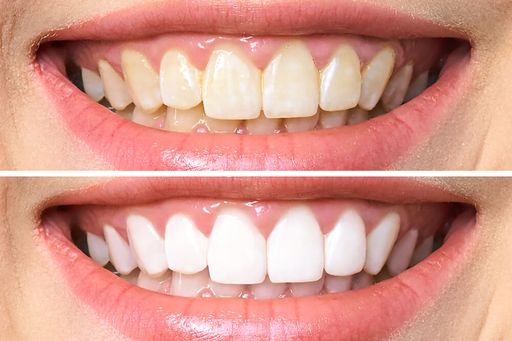 Домашнее отбеливание зубов: полезные и безопасные советы
